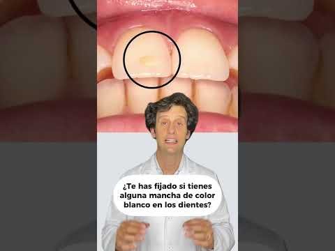 Cómo quitar las manchas de calcio en los dientes