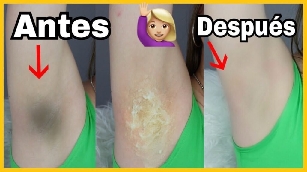 Cómo quitar las manchas de las axilas remedios caseros