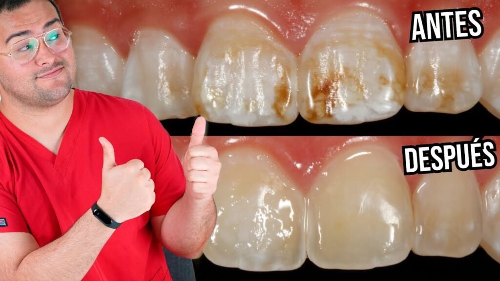Cómo quitar las manchas de los dientes