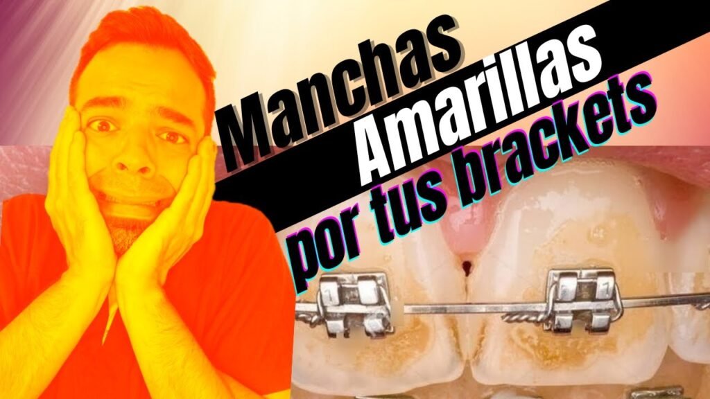 Cómo quitar las manchas de los dientes por brackets