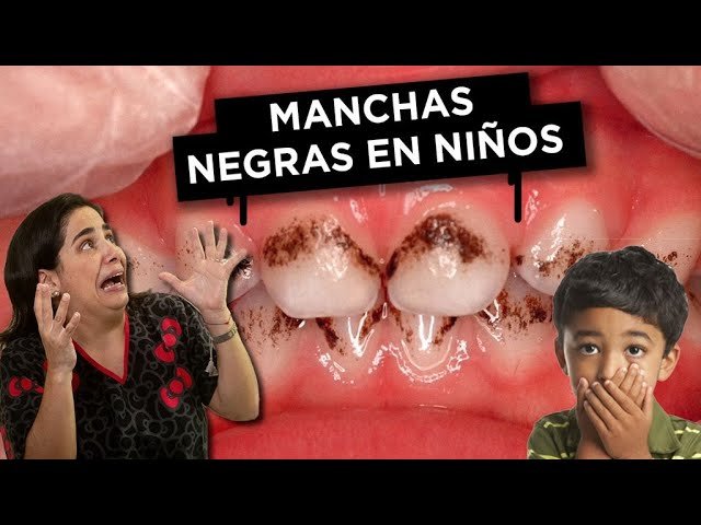 Cómo quitar las manchas negras de los dientes