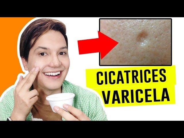 manchas de varicela Cómo quitarlas